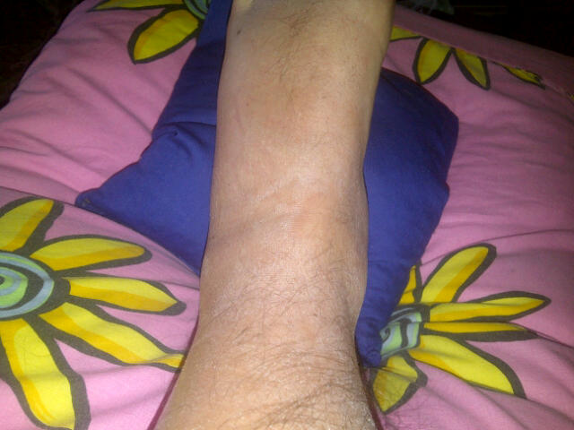 my ankle on day 3