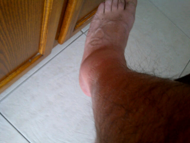 swollen ankle